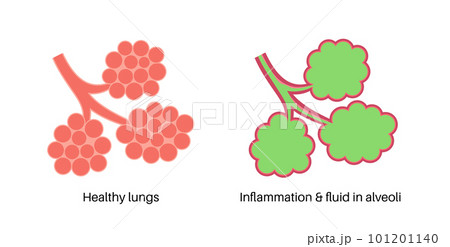 Pneumonia infection poster Pneumonia infection poster 101201140