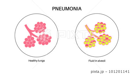 Pneumonia infection poster Pneumonia infection poster 101201141