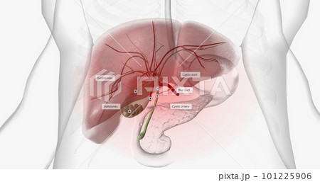 Gallstones are pieces of solid material that form in the gallbladder, a small hollow organ located beneath the liver. Gallstones are pieces of solid material that form in the gallbladder, a small hollow organ located beneath the liver. 101225906