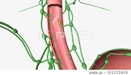 In stage I esophageal cancer, the tumor has spread through some of the layers of the esophageal wall. 101225929