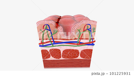 Anal fissure is a small tear in the lining of the anal mucosa. Anal fissure is a small tear in the lining of the anal mucosa. 101225931