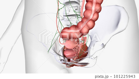 In stage IV, the cancer spreads to invade nearby organs, such as the bladder, rectum, and kidneys. 101225943