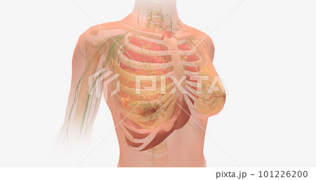 Stage IV breast tumors are invasive and have spread beyond the localized area to the lungs, bones, liver, brain, or to distant lymph nodes. 101226200