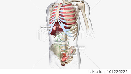 The Bladder Cancer, Stage IV The Bladder Cancer, Stage IV 101226225