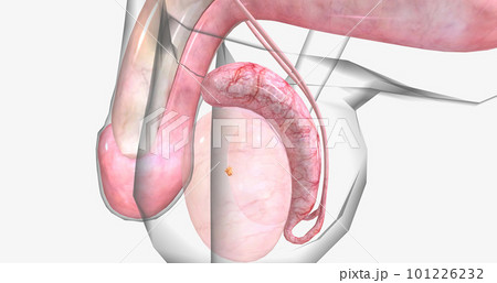 Testicular tumors are the most common type of solid cancerous tumors in men between the ages of 15 and 35. 101226232