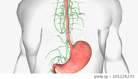 In stage I esophageal cancer, the tumor has spread through some of the layers of the esophageal wall. In stage I esophageal cancer, the tumor has spread through some of the layers of the esophageal wall. 101226235