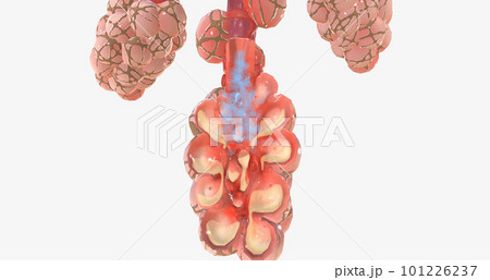 COVID-19, Acute Respiratory Distress Syndrome COVID-19, Acute Respiratory Distress Syndrome 101226237