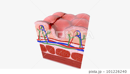 Anal fissure is a small tear in the lining of the anal mucosa. Anal fissure is a small tear in the lining of the anal mucosa. 101226240