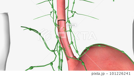 In stage I esophageal cancer, the tumor has spread through some of the layers of the esophageal wall. 101226241