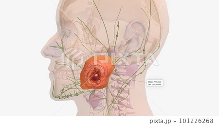 Basal Cell Carcinoma in Tissue, Stage IV Basal Cell Carcinoma in Tissue, Stage IV 101226268