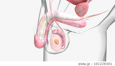 Stage I testicular cancer is characterized by a tumor that has not spread to the lymph nodes or other organs. 101226301