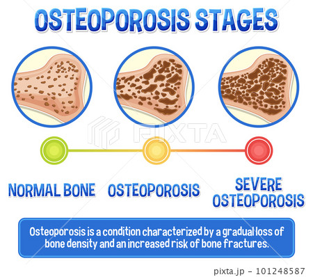Informative poster of Osteoporosis human bone 101248587