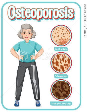 Comparison of normal bone and bone with Osteoporosis in old people 101248588