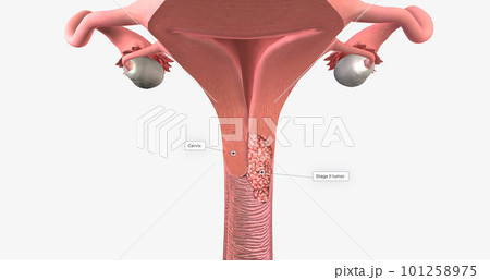 In stage II, the cancer has invaded the upper part of the vagina and tissue near the uterus called the parametrium. 101258975