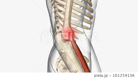 Tennis elbow, also called epicondylitis, is a painful condition caused by repetitive movement of the elbow. 101259136
