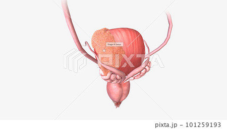 The Bladder Cancer, Stage III 101259193