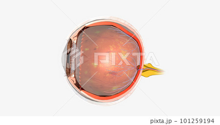 Diabetic retinopathy is a complication of diabetes that affects the eyes. 101259194