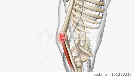 Tennis elbow, also called epicondylitis, is a painful condition caused by repetitive movement of the elbow. Tennis elbow, also called epicondylitis, is a painful condition caused by repetitive movement of the elbow. 101259239