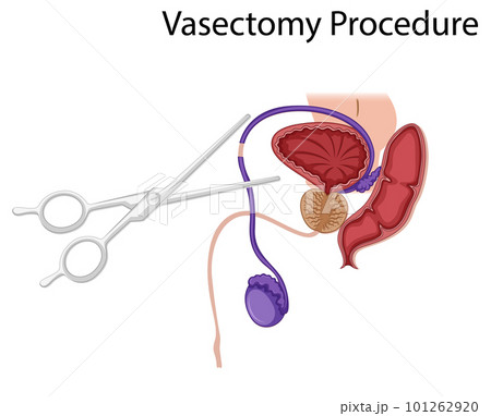 Diagram showing Vasectomy Procedure 101262920