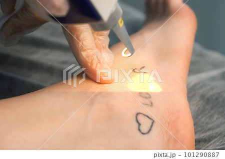 Laser removing of tattoo with words loser, lover and heart on woman's foot. 101290887