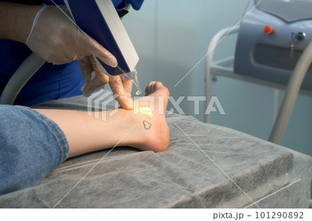Laser removing of tattoo with words loser, lover and heart on woman's foot. 101290892