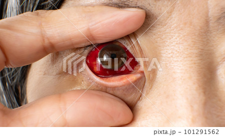 目の充血　アップ　片目 101291562