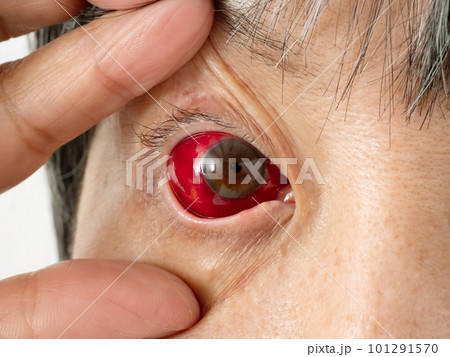 目の充血 アップ 片目 目の充血 アップ 片目 101291570