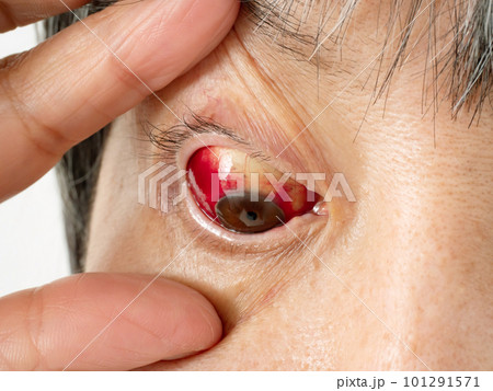 目の充血　アップ　片目 101291571