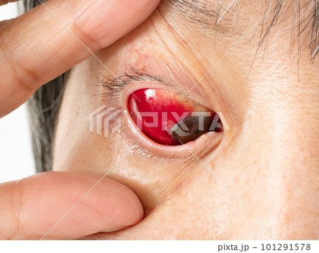 目の充血　アップ　片目 101291578