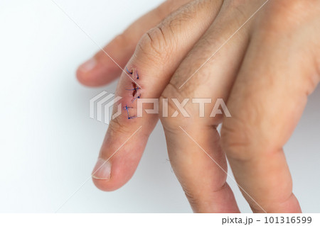 Stitched wound on a finger. Hand with stitched cut wound 101316599