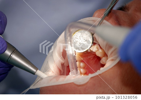 Kiev, Ukraine August 22, 2020: Dentist doctor works with a patient close-up 101328056