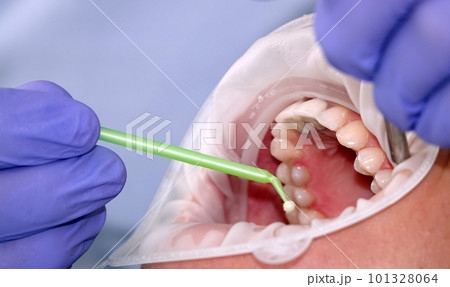 Kiev, Ukraine August 22, 2020: Dentist doctor works with a patient close-up 101328064