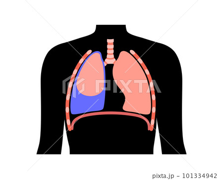 Pleural effusion poster 101334942