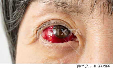 充血 結膜炎 目 充血 結膜炎 目 101334966