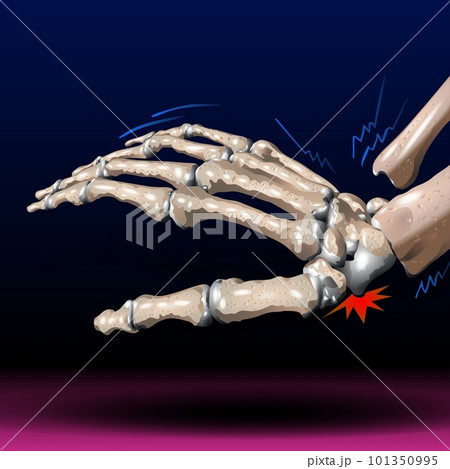 Palm Bone Fracture Palm Bone Fracture 101350995