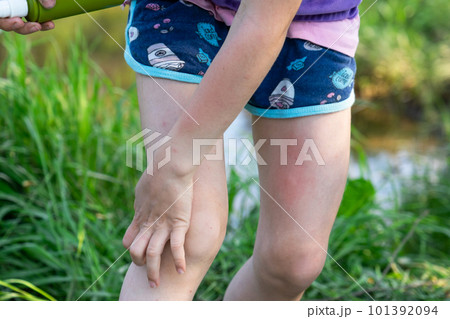 Girl sprays mosquito spray on the skin in nature that bite her hands and feet. Protection from insect bites, repellent safe for children. Outdoor recreation, against allergies. Summer time Girl sprays mosquito spray on the skin in nature that bite her hands and feet. Protection from insect bites, repellent safe for children. Outdoor recreation, against allergies. Summer time 101392094