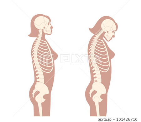Neck vertebrae deformity Neck vertebrae deformity 101426710