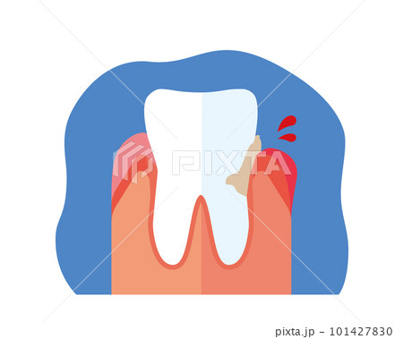 歯ぐきの腫れ出血 101427830