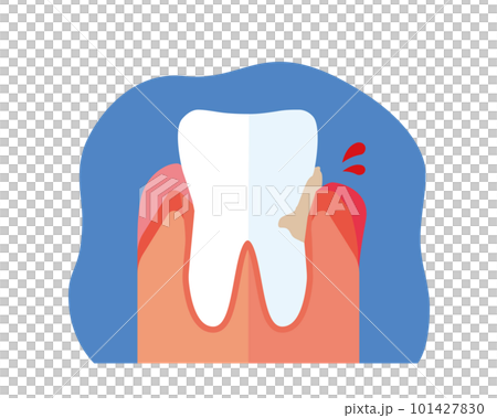 歯ぐきの腫れ出血 101427830