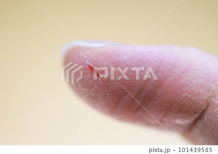 指先にできたあかぎれ 指先にできたあかぎれ 101439585