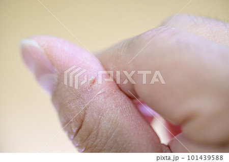 指先にできたあかぎれ 指先にできたあかぎれ 101439588