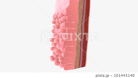 Adenocarcinoma of the esophagus results from abnormal cell mutations and growth in the esophageal lining, or mucosa. Adenocarcinoma of the esophagus results from abnormal cell mutations and growth in the esophageal lining, or mucosa. 101443140