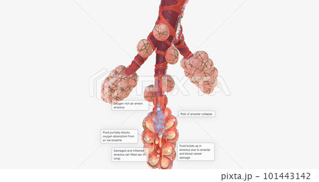 COVID-19, Acute Respiratory Distress Syndrome 101443142