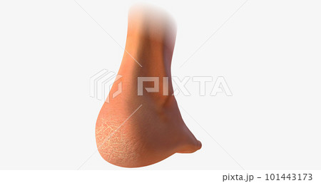A callus is an area of thickened, hardened skin that develops as a result of frequent rubbing or repetitive motion. A callus is an area of thickened, hardened skin that develops as a result of frequent rubbing or repetitive motion. 101443173