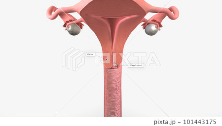 In stage I, the cancer is very small and confined to the cervix 101443175