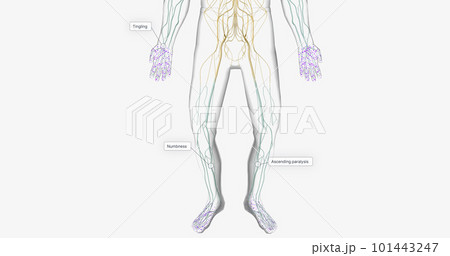 Guillain Barre syndrome is a rare disorder in which your body's immune system attacks your nerves. 101443247