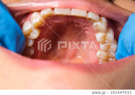 Close-up of the upper jaw, hard palate, soft palate, teeth and gums of a middle-aged woman. 101447033