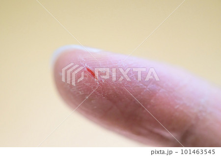 指先にできたあかぎれ 101463545