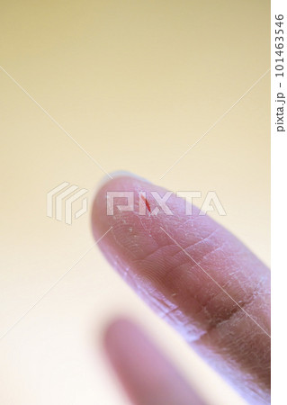 指先にできたあかぎれ 指先にできたあかぎれ 101463546