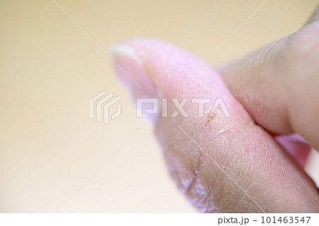 指先にできたあかぎれ 101463547